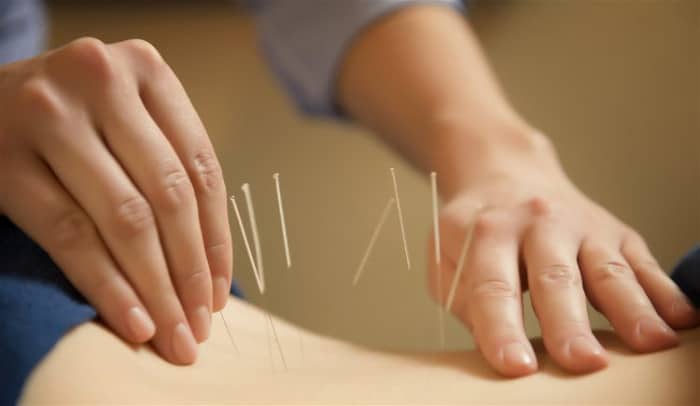 Pros And Cons Of Dry Needling